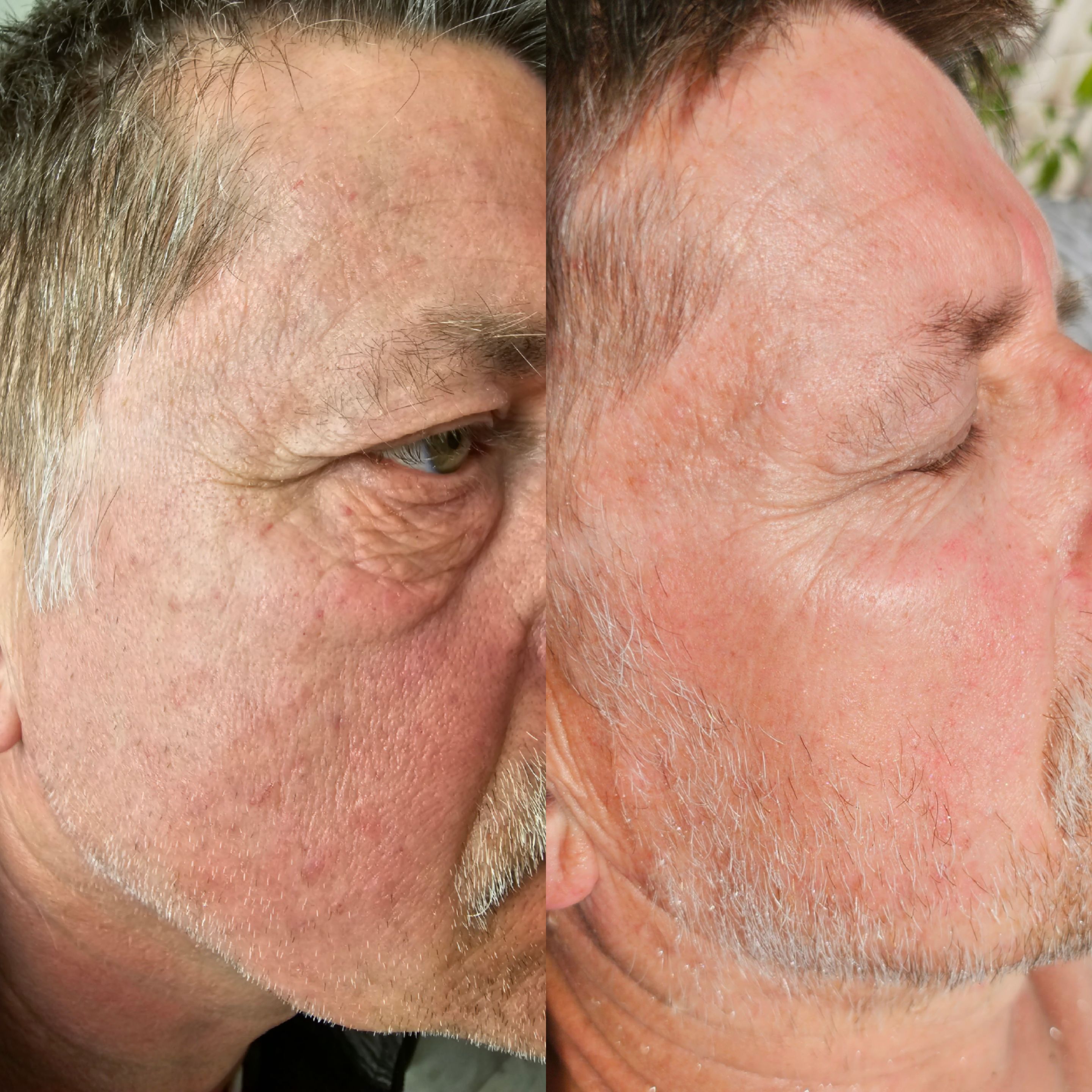 Efekt zabiegu kosmetologicznego - SkinLab Bydgoszcz