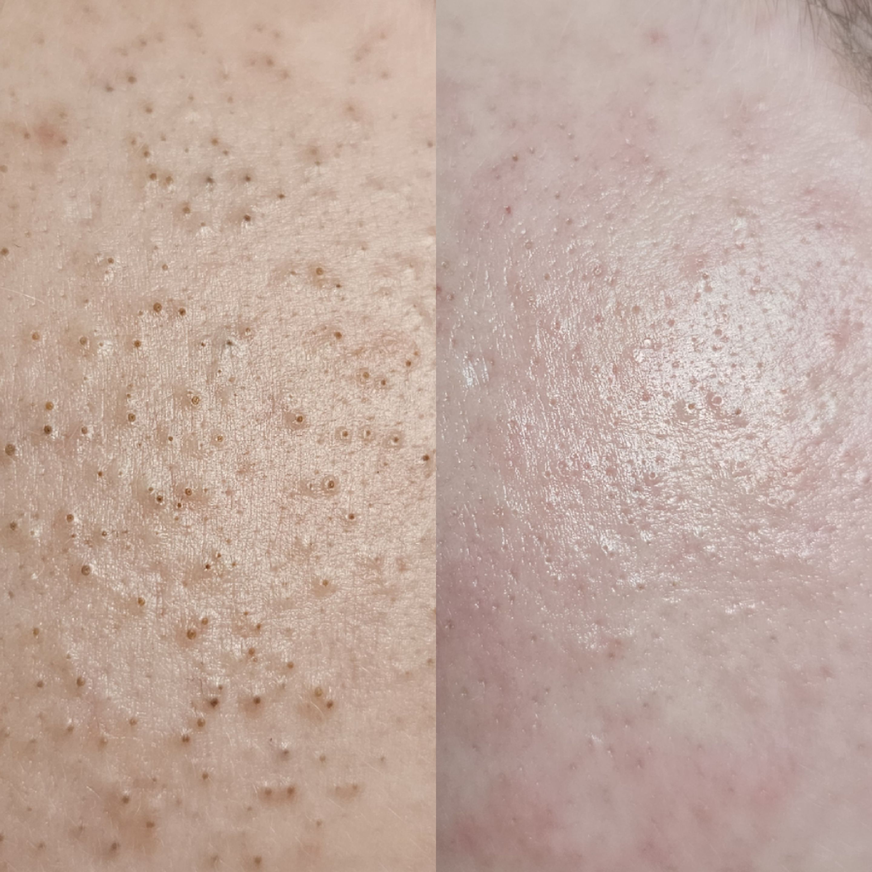 Efekt zabiegu kosmetologicznego - SkinLab Bydgoszcz