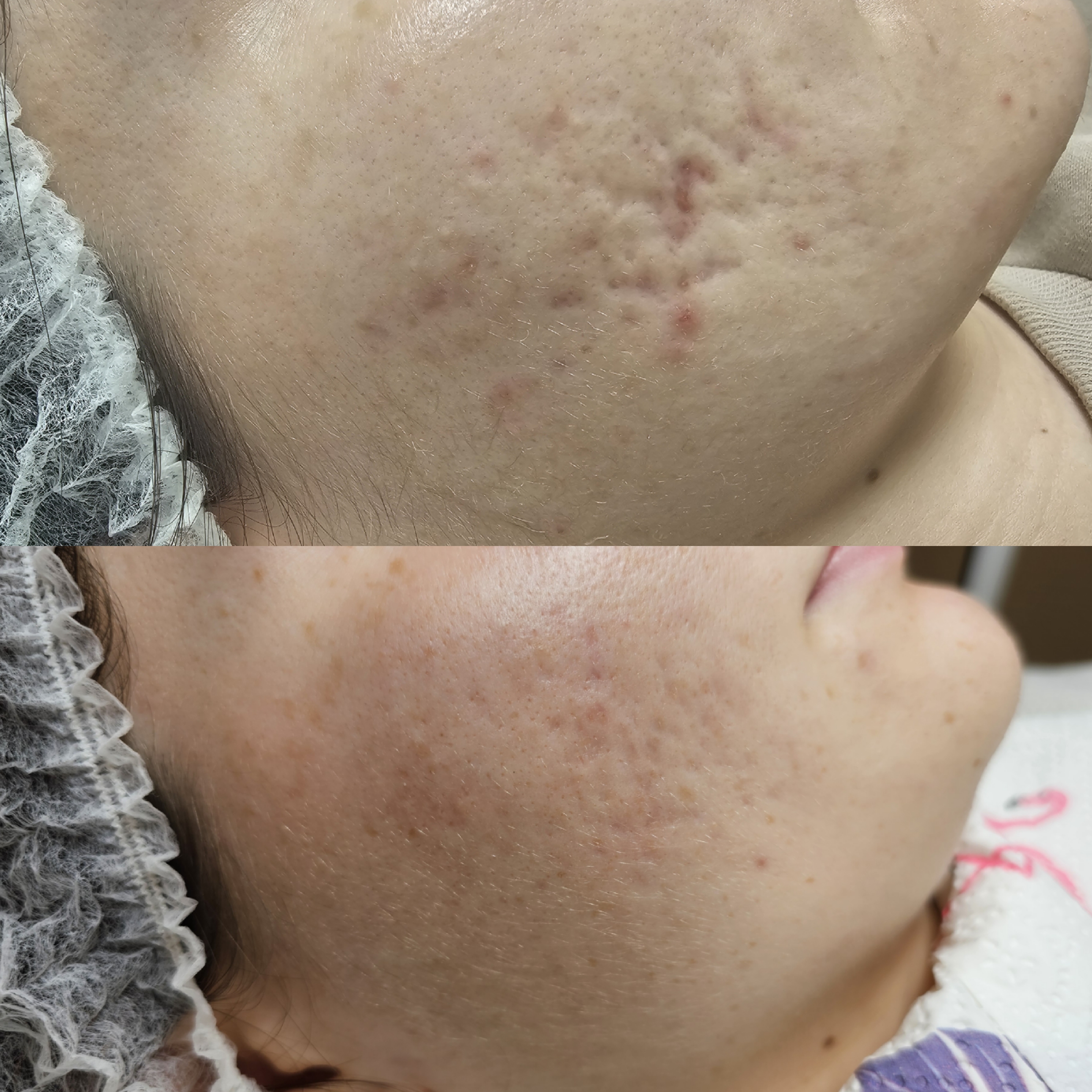 Efekt zabiegu kosmetologicznego - SkinLab Bydgoszcz