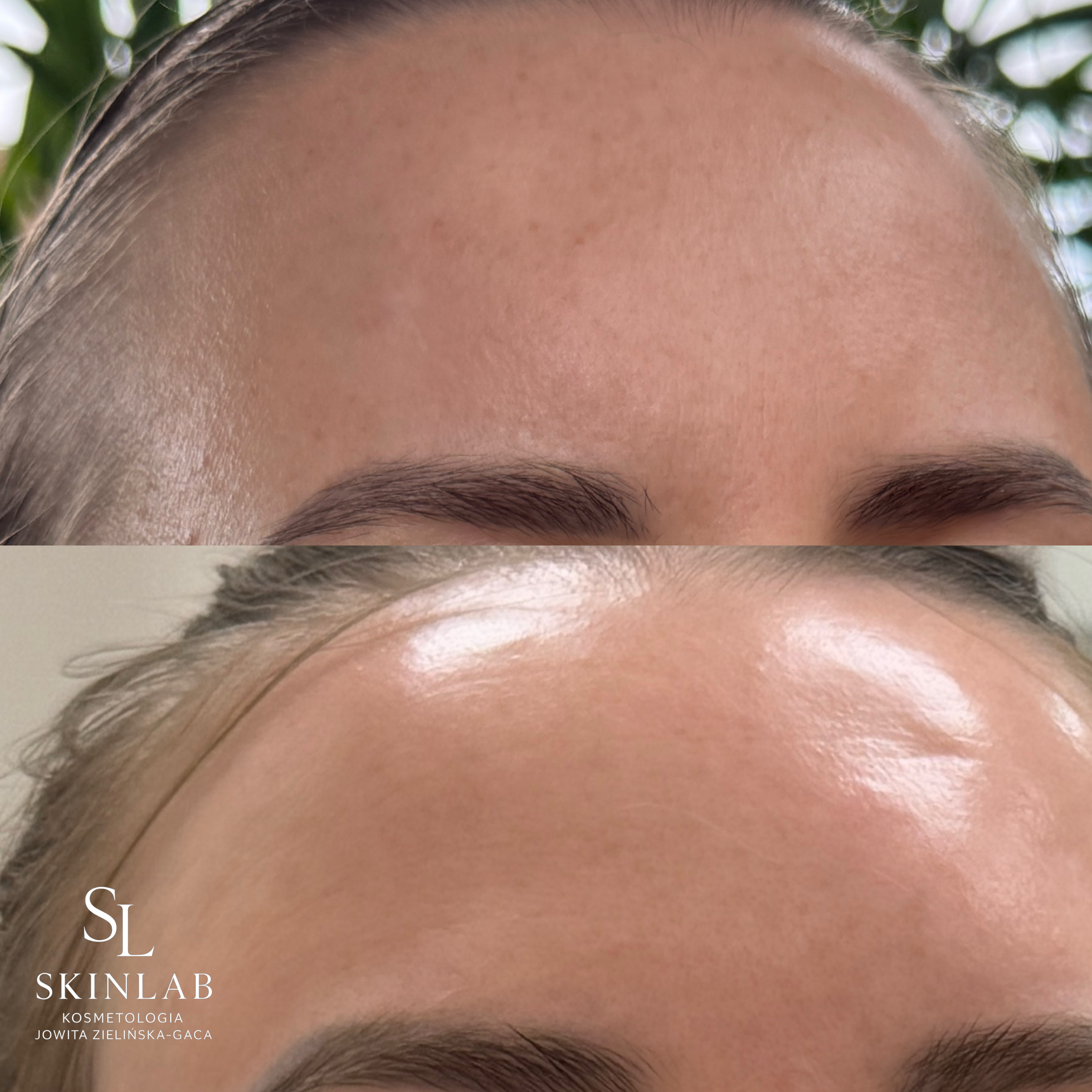 Efekt zabiegu kosmetologicznego - SkinLab Bydgoszcz