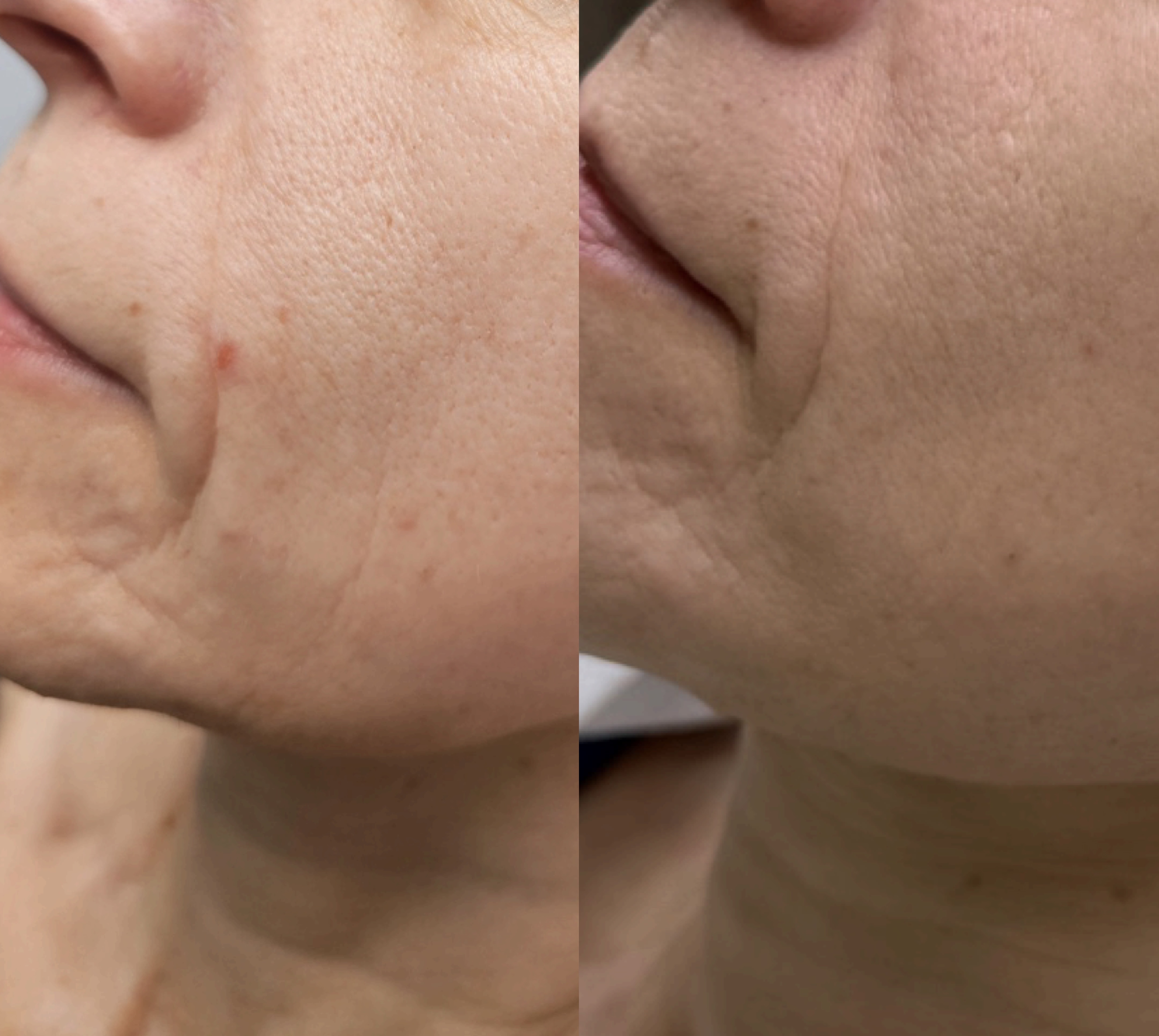 Efekt zabiegu kosmetologicznego - SkinLab Bydgoszcz