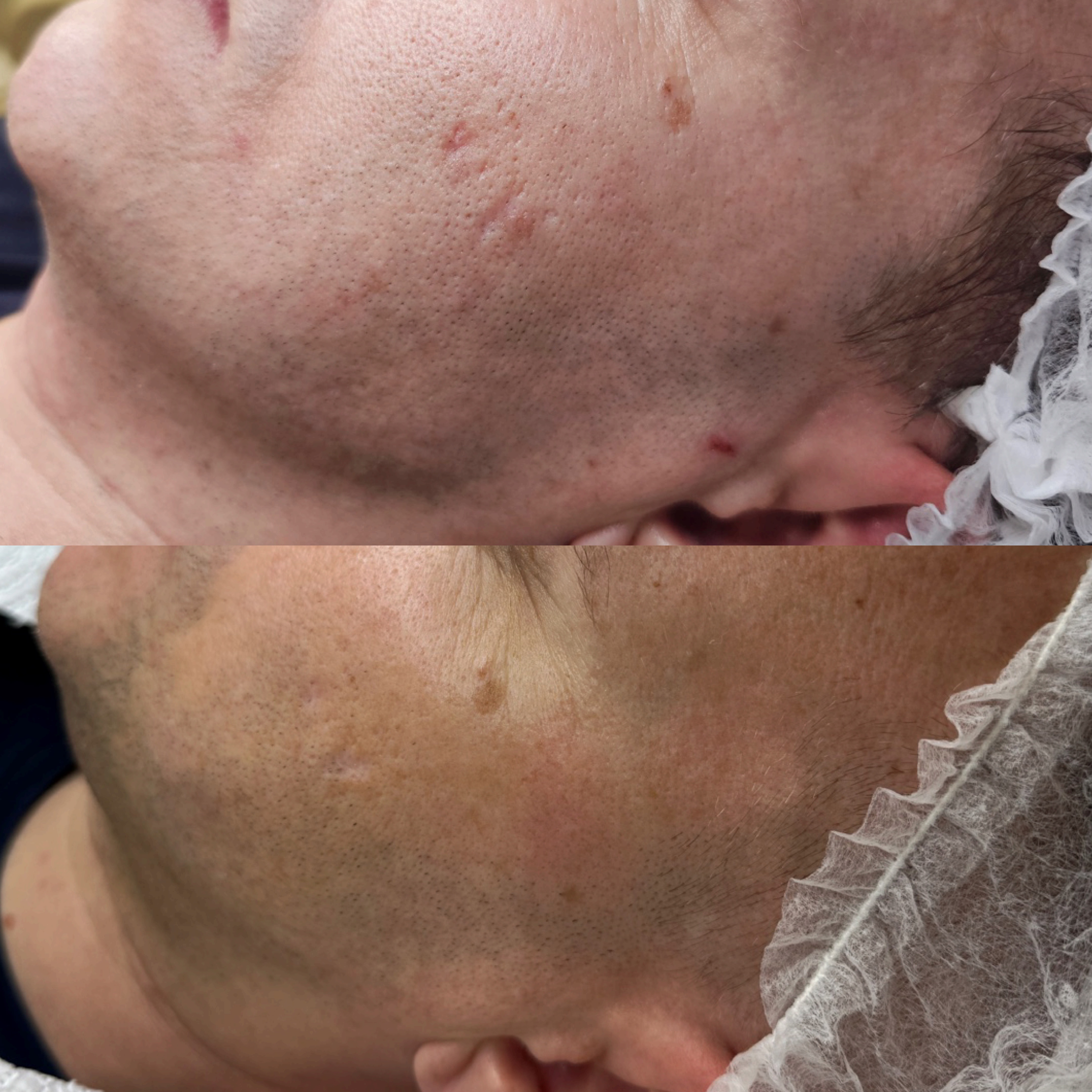 Efekt zabiegu kosmetologicznego - SkinLab Bydgoszcz