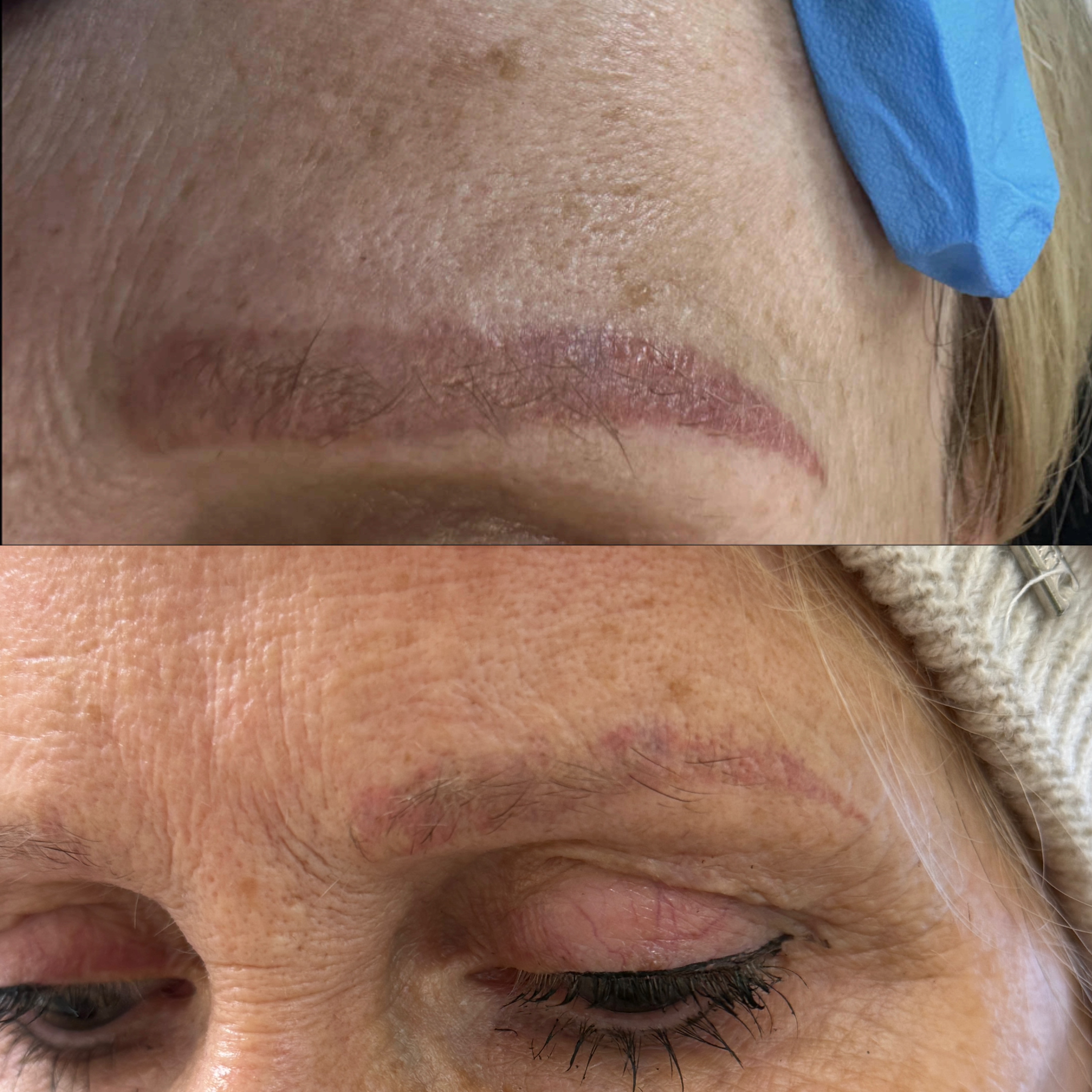 Efekt zabiegu kosmetologicznego - SkinLab Bydgoszcz