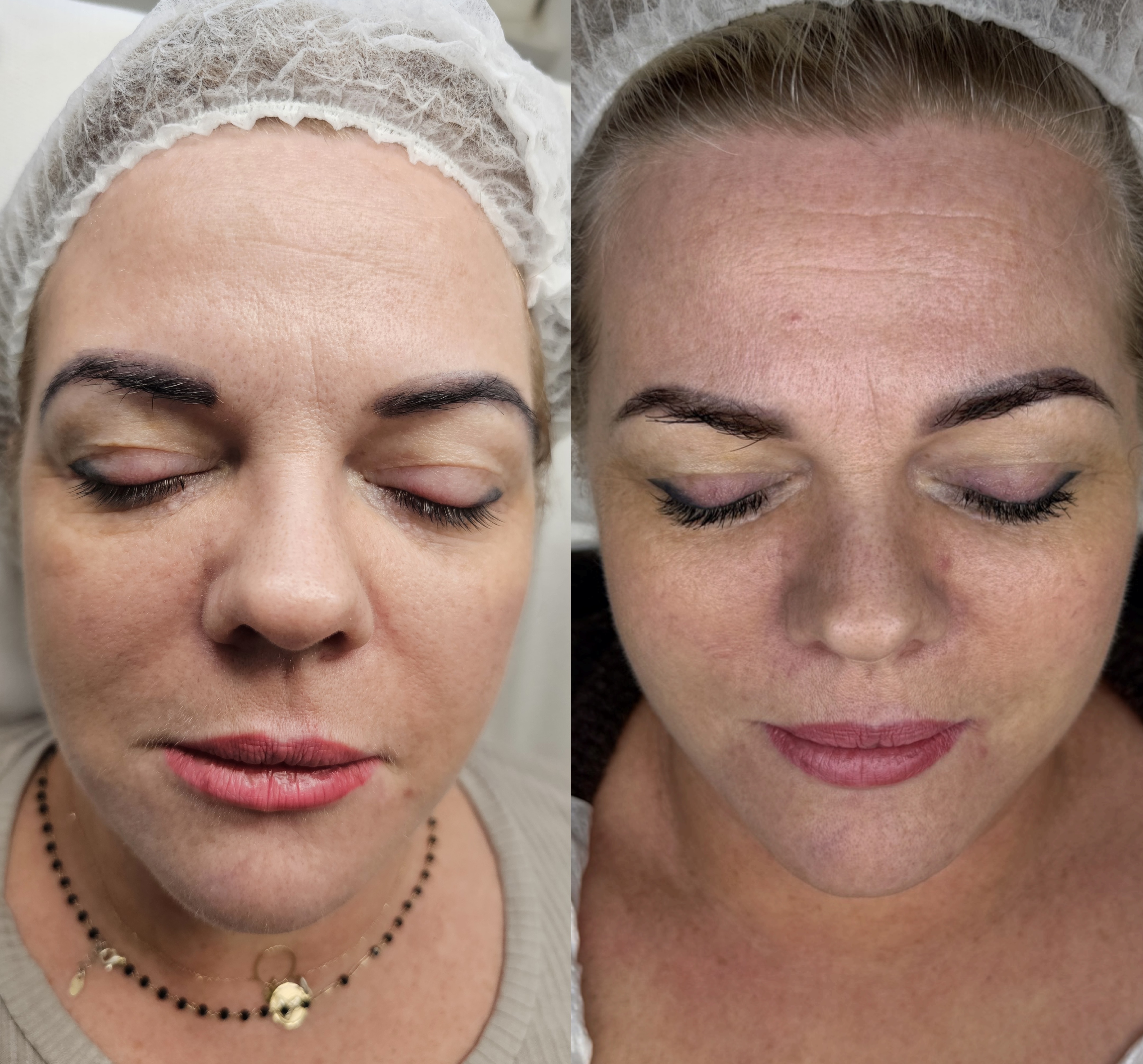 Efekt zabiegu kosmetologicznego - SkinLab Bydgoszcz