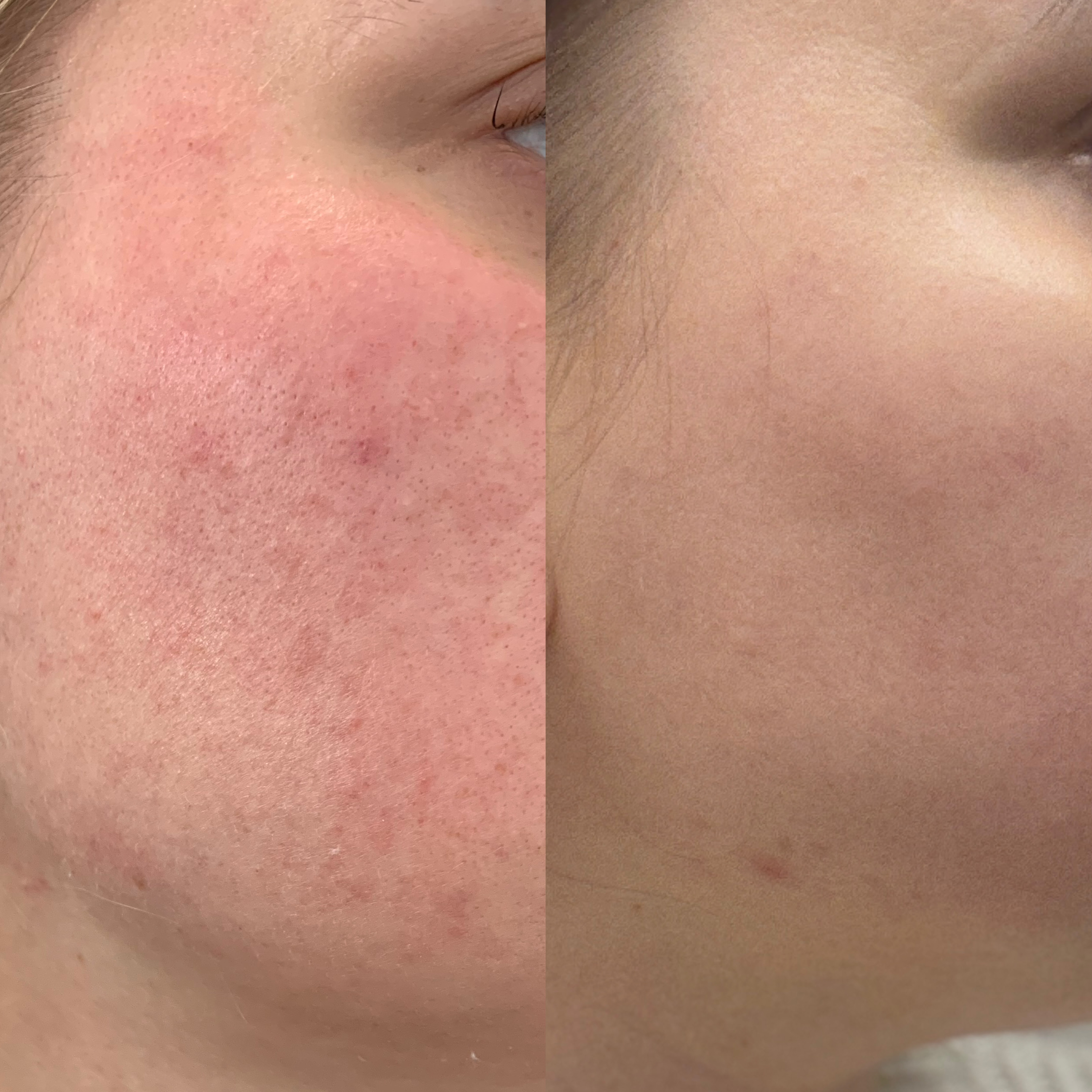 Efekt zabiegu kosmetologicznego - SkinLab Bydgoszcz